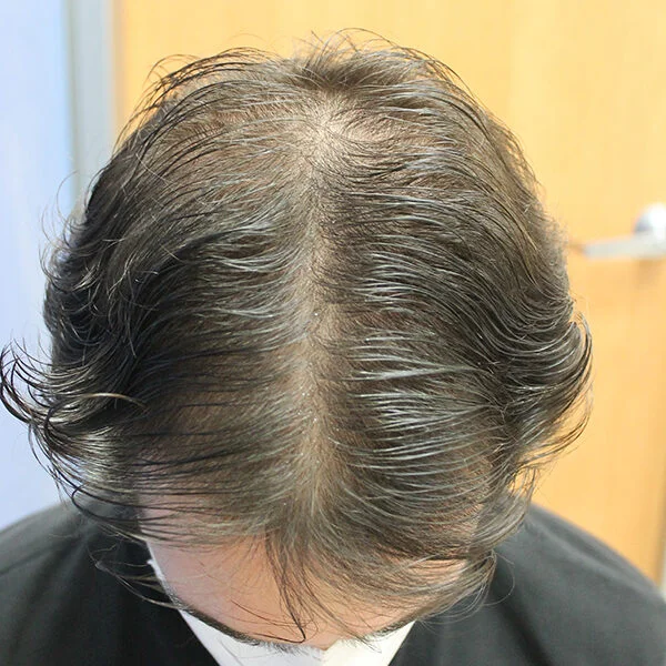 Antes alopecia tratamiento