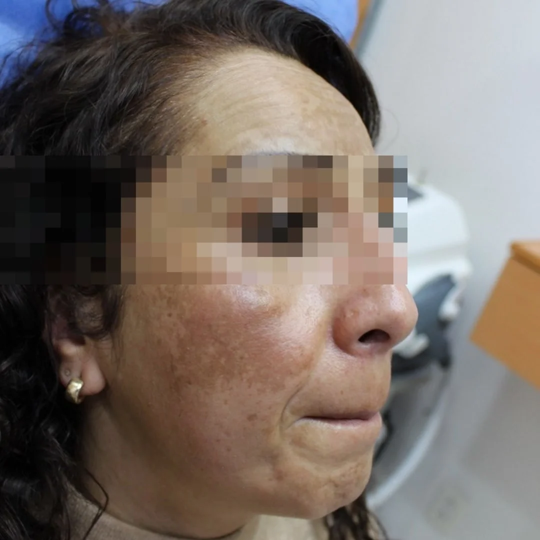 Antes tratamiento acné