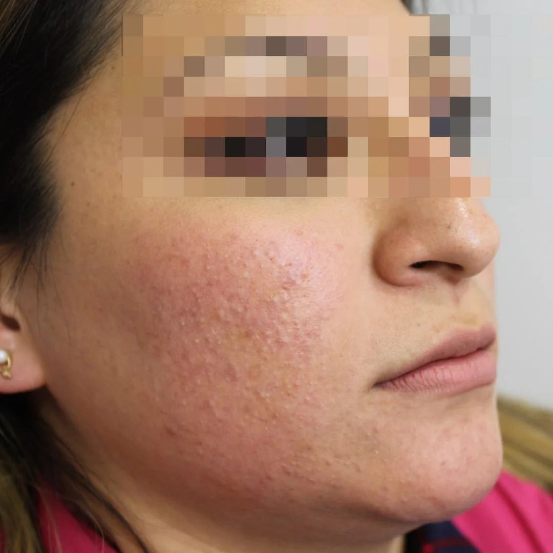 Antes tratamiento dermatológico