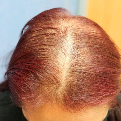 Antes alopecia mujer