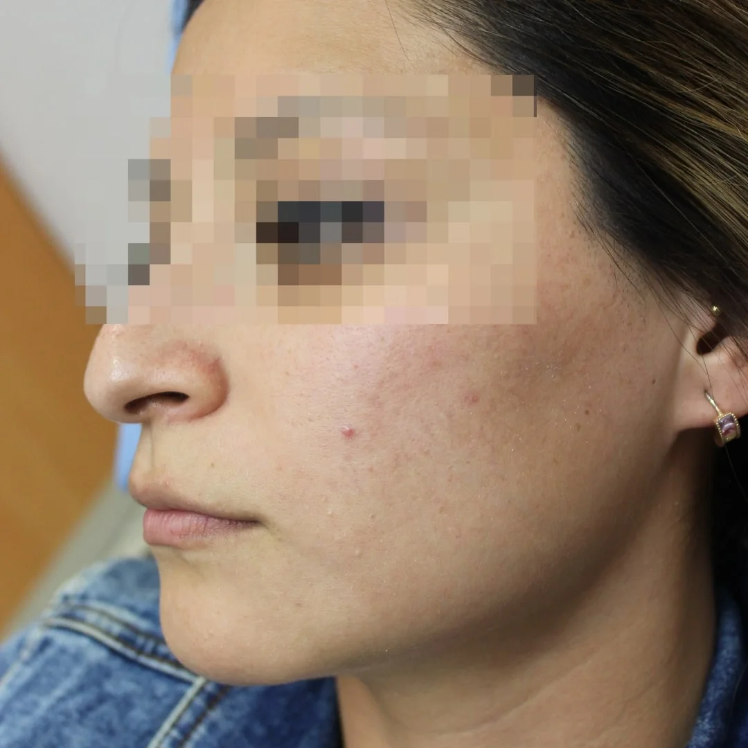Después tratamiento acné