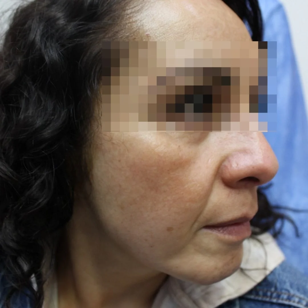 Después tratamiento acné