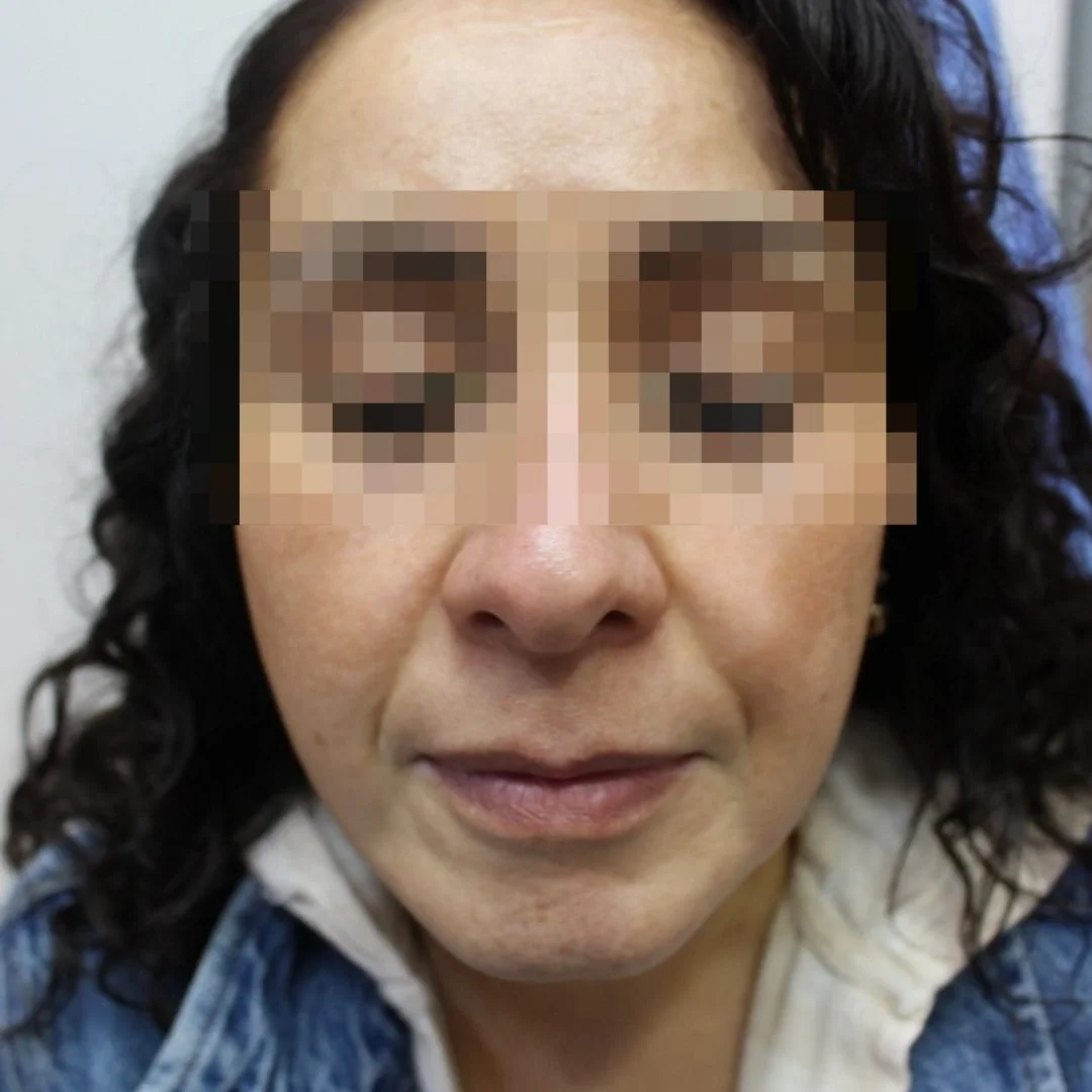 Después manchas hiperpigmentación