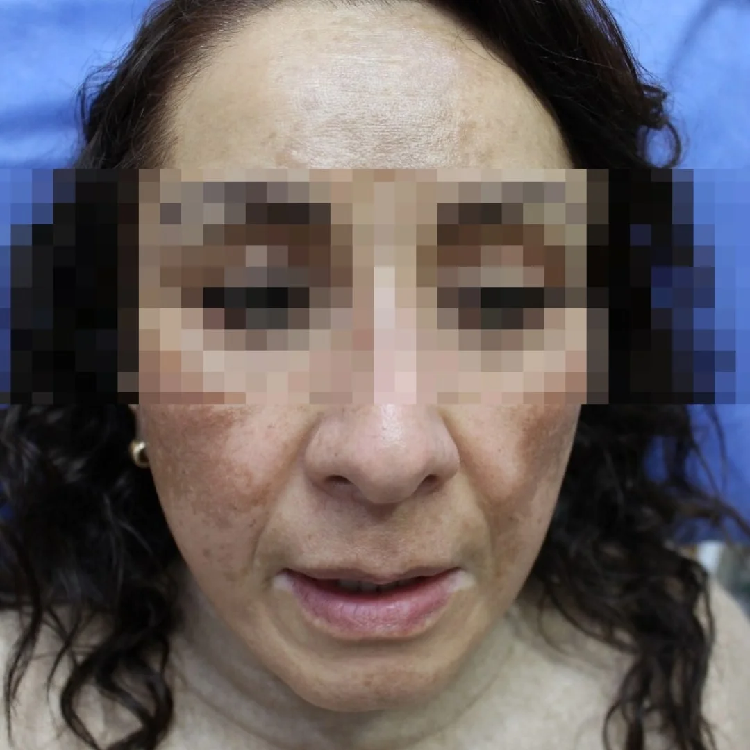 Antes manchas hiperpigmentación