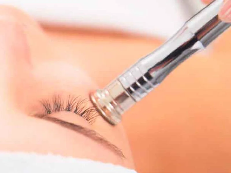 Microdermoabrasión Puebla